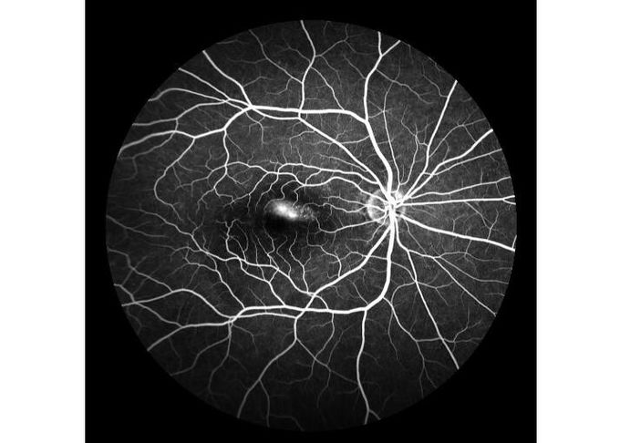 광학의 줌 100' /60' /30'과 초광폭 분야 레이저 주사 망막 혈관조영상 디지털 눈 장비